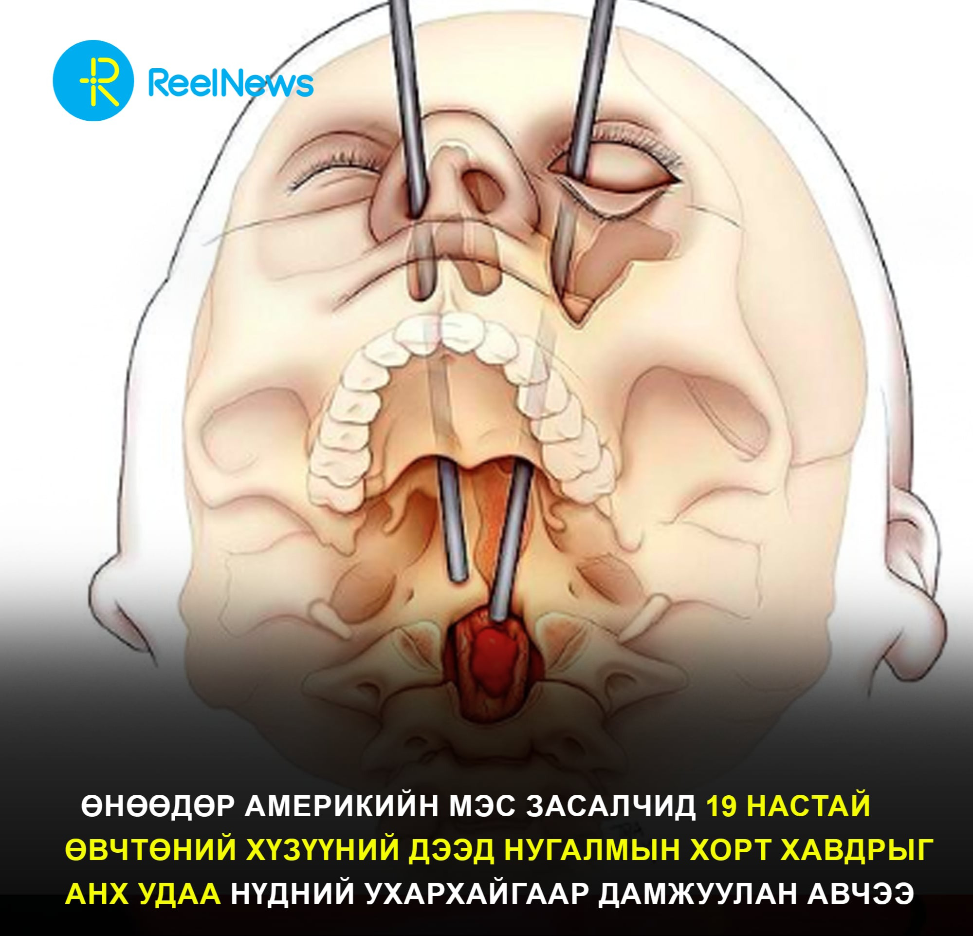Америкийн мэс засалчид 19 настай өвчтөний хүзүүний дээд нугалмын хорт хавдрыг анх удаа нүдний ухархайгаар дамжуулан авчээ.